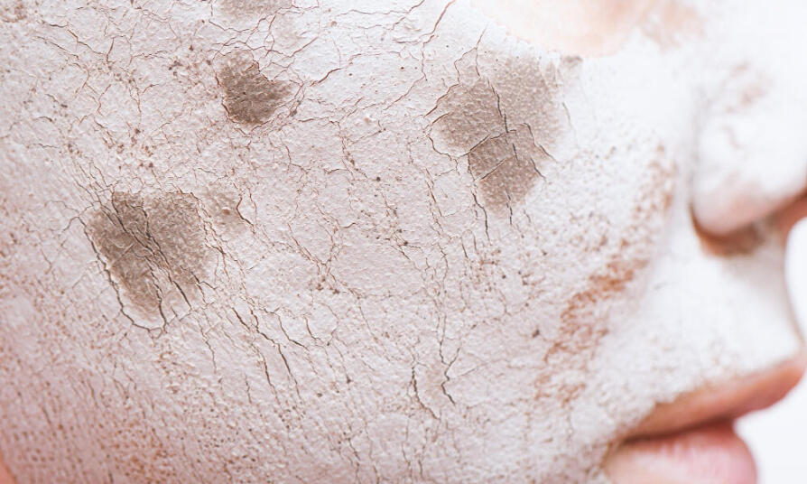 Popraskaná pleť – aj vás trápi počas chladných mesiacov? Ako si pomôcť?