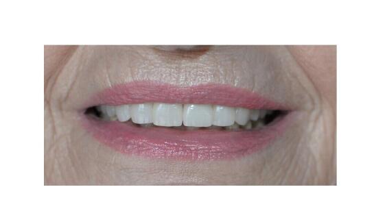 Stomatochirurgia v Bratislave: odborné riešenie zložitejších zubných problémov