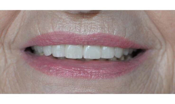 Estetická stomatológia v Bratislave: aké zákroky vedú ku krajšiemu úsmevu?