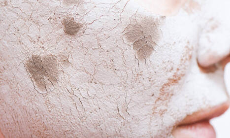 Popraskaná pleť – aj vás trápi počas chladných mesiacov? Ako si pomôcť?